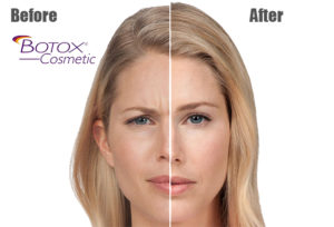 botox before and after at Carrington medical Center in Trussville Alabama
