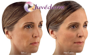 juvederm before and after at Carrington medical Center in Trussville Alabama
