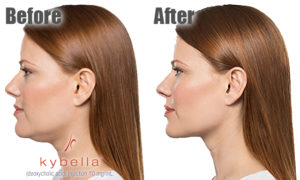 kybellba before and after at Carrington medical Center in Trussville Alabama