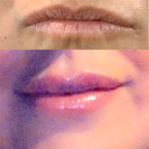 a lip before and after photo